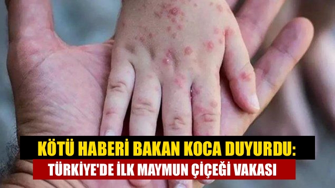 Sağlık Bakanı Fahrettin Koca, Türkiye'de ilk maymun çiçeği vakasının tespit
